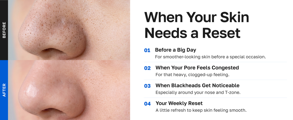 When your skin needs a reset: before a big day, congested pores, noticeable blackheads, your weekly reset